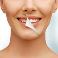 teeth-whitening-189x187