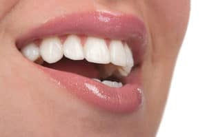 veneers 300x199 1