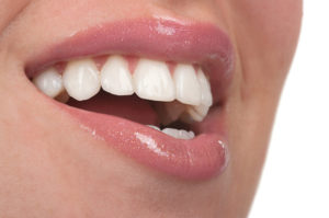 veneers