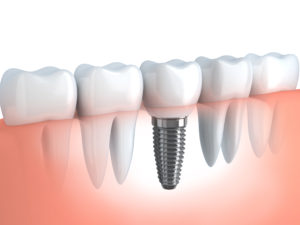 tooth implant Metuchen nj