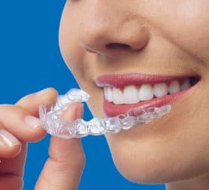 Invisalign 300x272 1