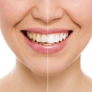 Teeth Whitening Edison, NJ