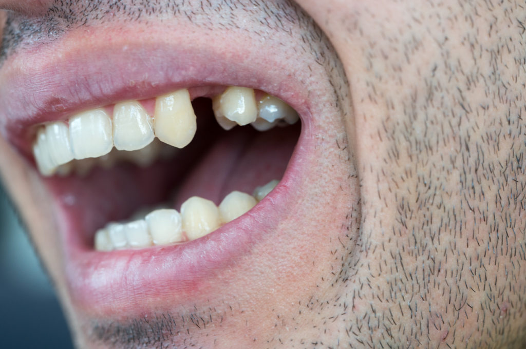 Knocked out tooth | Emergency dentist Edison
