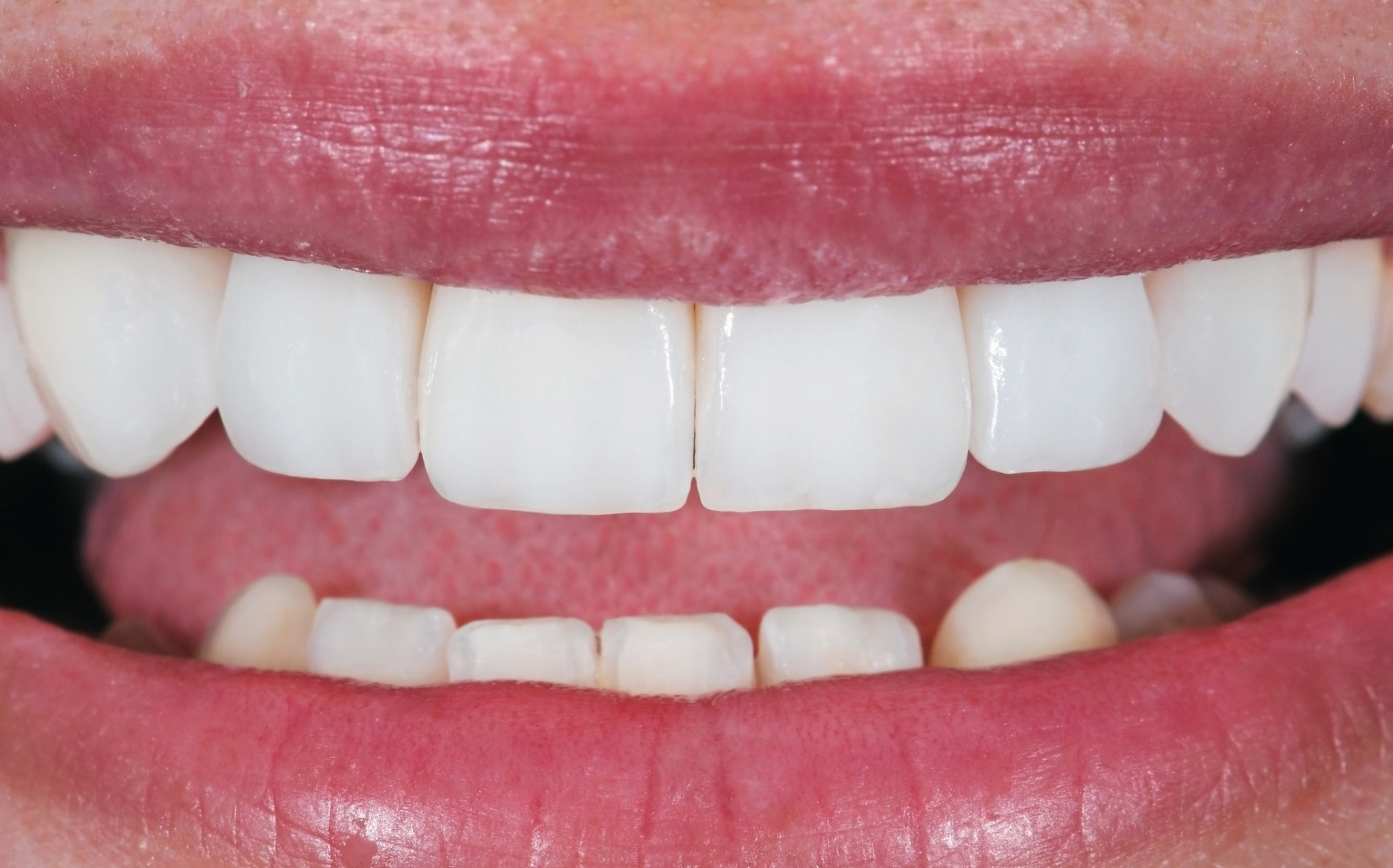 Best Dental Veneers Edison NJ Porcelain Veneers Metuchen NJ