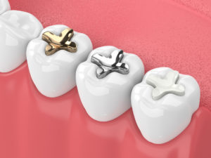 3d render of jaw with teeth and three types of inlay over white