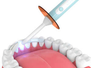 3d render of jaw with dental polymerization lamp and dental fiber over white background