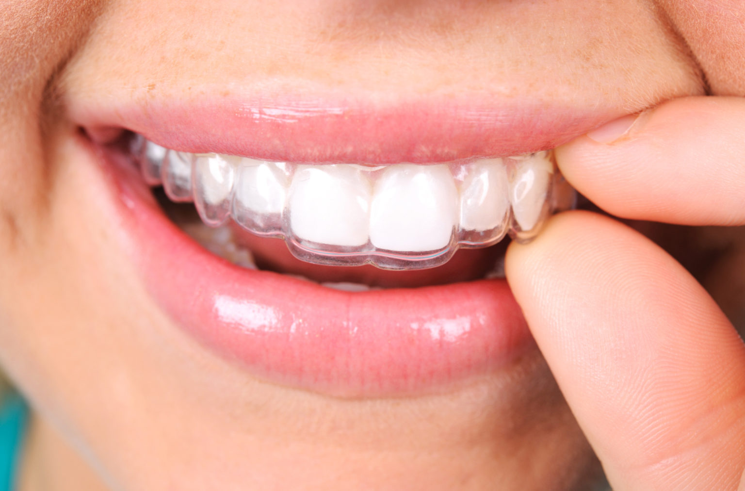 iTero for Invisalign in Edison, NJ | iTero Scanner Edison NJ
