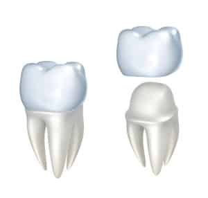 Dental Crowns & Bridges Edison NJ