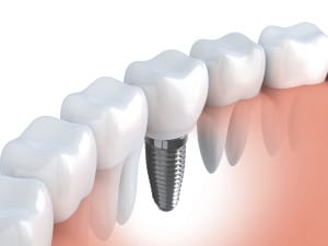dental implantsjpg 300x225 1