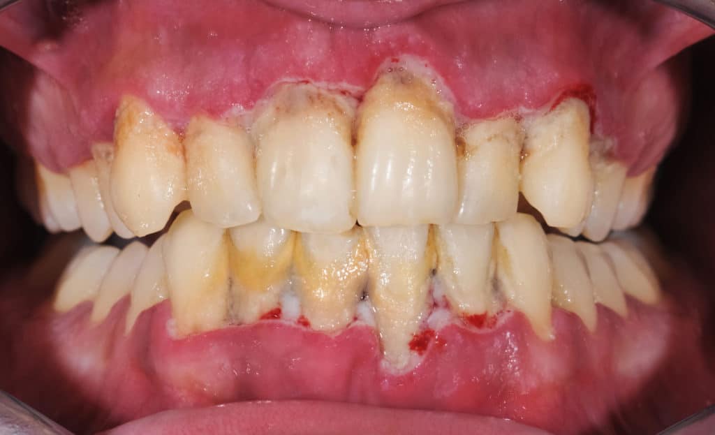 Extreme close up of gums and teeth that are very infected with periodontal disease