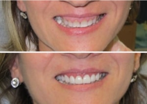 veneers edison nj 300x214 1