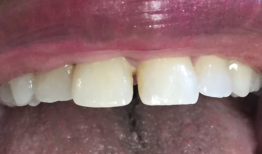 Dental Bonding Gentle Dental Care