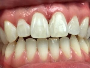 Cosmetic Bonding