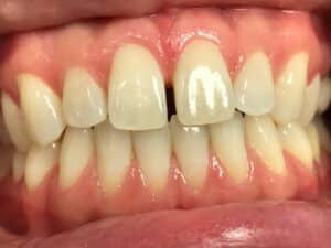 Cosmetic Bonding