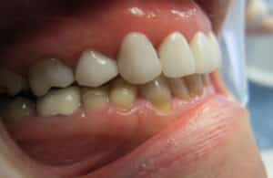 Veneers