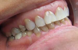 Veneers