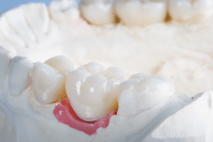 dental crown