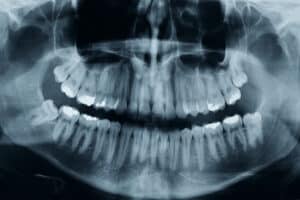 Dental,Xray,Shows,3,Wisdom,Tooths.,There,Is,One,Critical