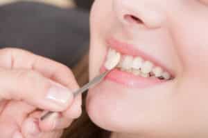 A woman smiling while having veneers held up to her teeth