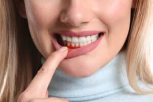 Woman showing red gums as an early sign of gum disease.