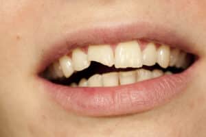 Close up of woman's mouth with broken front tooth.