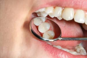 Close-up of a patient's mouth, taking a closer look at their dental fillings to restore a damaged tooth.