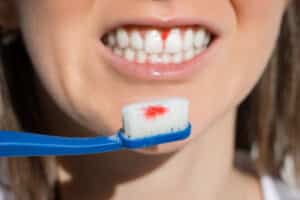 Close-up of a woman brushing her teeth and showing a little bit of blood on the brush from her irritated gums.