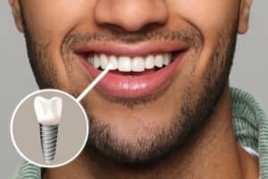 Close up of a patient's smile with bright, shiny, and straight teeth and a diagram showing that one is an implant.