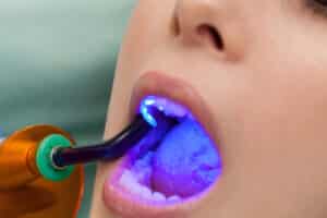 Close-up of a patient having a dental filling cured with a UV light to ensure it has a long, strong lifespan.