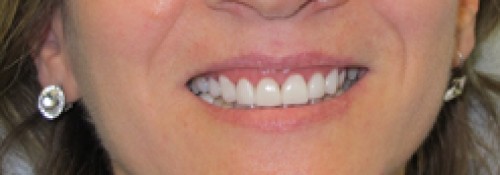 Porcelain Veneers – 1