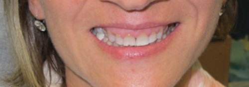 Porcelain Veneers – 1